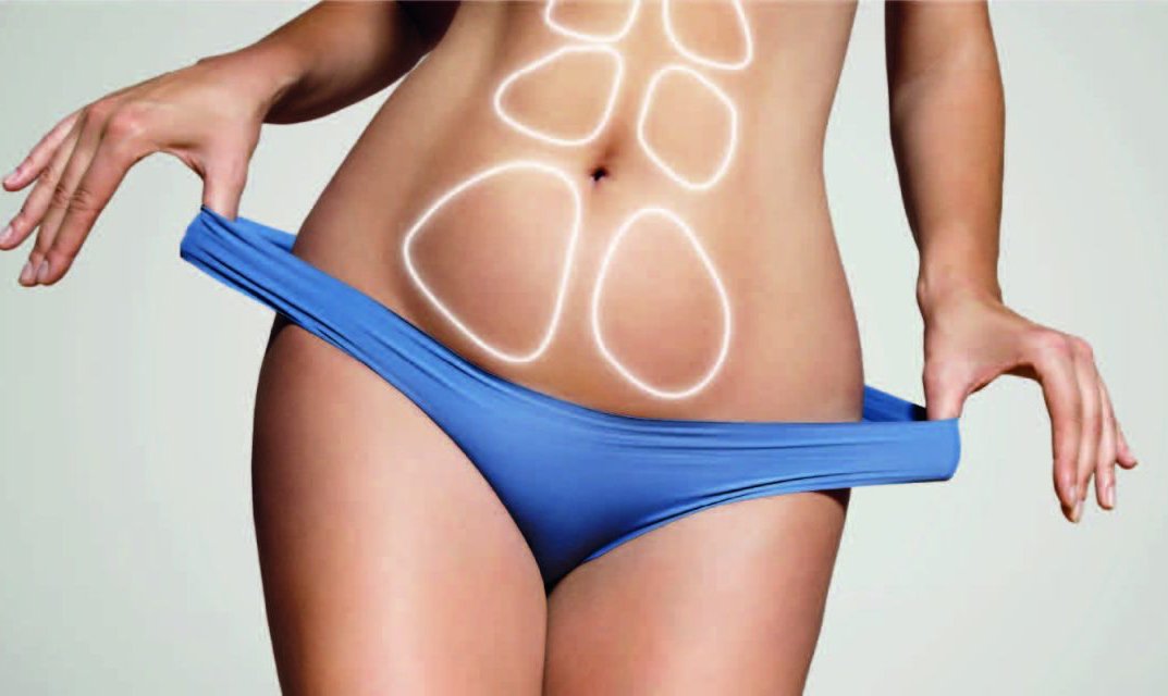 Bauchdeckenstraffung (Abdominoplastik)