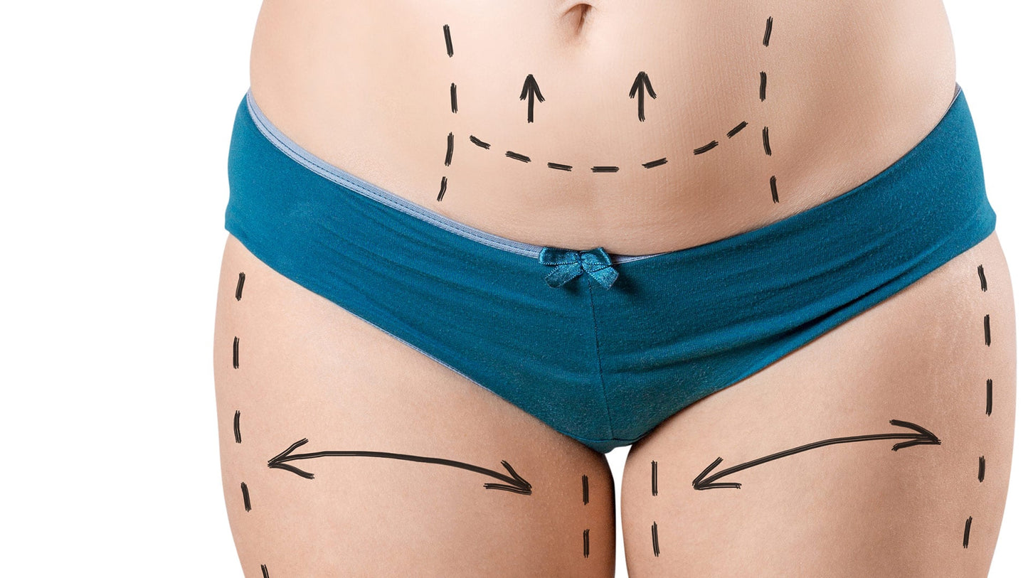 Genitalästhetik (Vaginoplastik / Labioplastik)