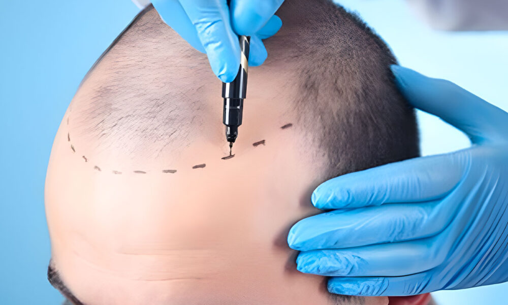 Haartransplantation (FUE - Follikuläre Einheit Extraktion)