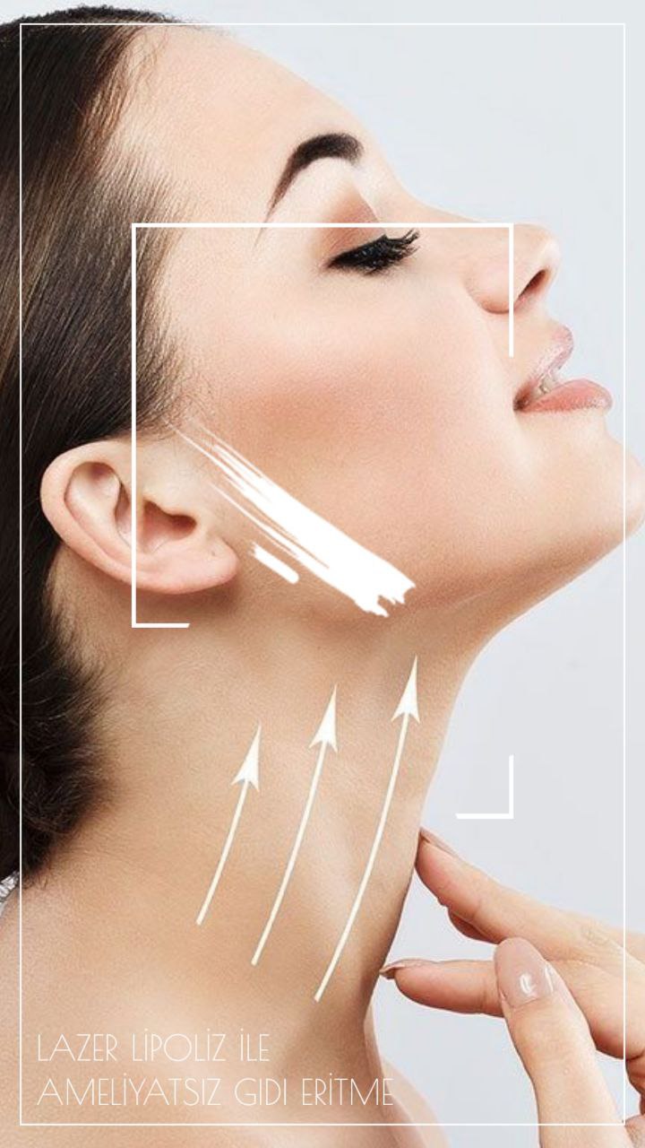 THERASET PLLA (Poly-L-Milchsäure) Kollagen